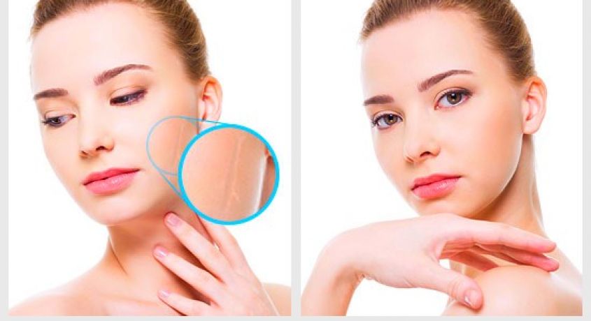 Избавьтесь от морщин, рубцов и растяжек (стрий)! Универсальная процедура оздоровления кожи со скидкой 70%.