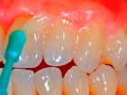 Лечение гиперестезии эмали (глубокое фторирование эмали 1-го зуба ЭГЛ)