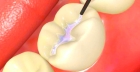 Лечение некариозных поражений тканей зуба с постановкой пломбы световой полимеризации, герметизация фиссур