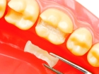 Восстановление культи зуба под ортопедическую коронку материалами световой полимеризации по поводу кариеса