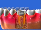Лечение пульпита и подготовка 3-канального зуба к протезированию