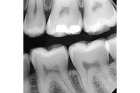Снимок зуба
