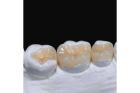 Восстановление зуба боковой области