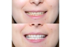 Отбеливание зубов системой Amazing White