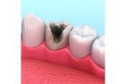 Лечение пульпита постоянного зуба (1 канал) + частичная реставрация (2 посещение)