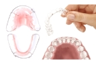 Постановка ретейнера (2 зуба между собой) 