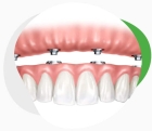 Покрывной зубной протез на имплантах