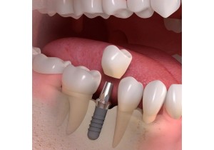 Протезирование зубов нижней челюсти 
