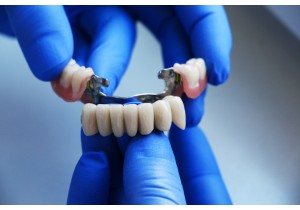 Мостовидное протезирование зубов 