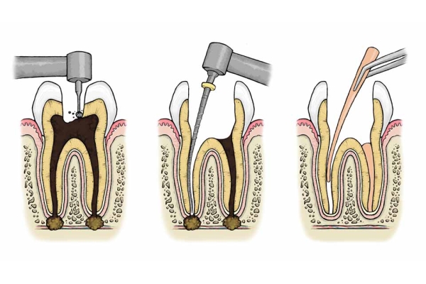 Лечение и пломбирование корневых каналов зуба