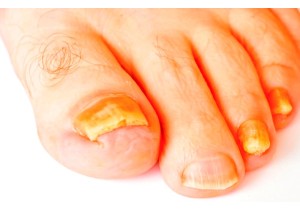 Лечение от грибков ногтей на ногах и руках