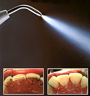 Ультразвуковая чистка зубов и AirFlow1