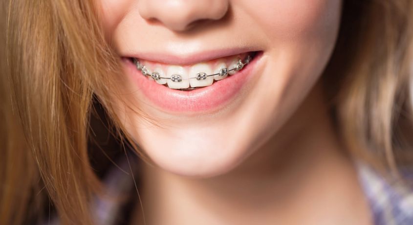 Ваш путь к идеальной улыбке! Скидка 50% на американские брекеты American Orthodontic от Сети медицинских клиник «Здравия»