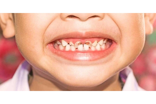 Лечение пульпита у детей постоянный зуб	