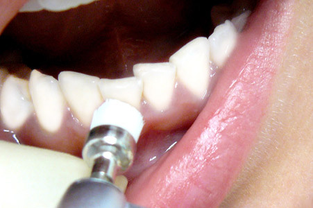 Ультразвуковая чистка зубов и AirFlow